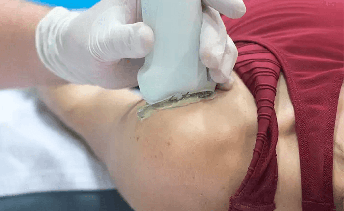 EPI® ayuda a desbloquear el proceso de recuperación del tejido