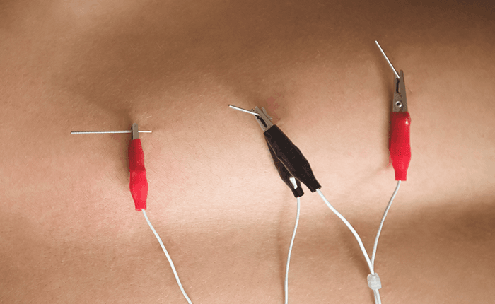 Neuromodulación y fisioterapia: cómo se integra en el tratamiento